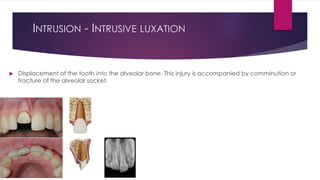 INTRUSION - INTRUSIVE LUXATION
 Displacement of the tooth into the alveolar bone. This injury is accompanied by comminution or
fracture of the alveolar socket.
 