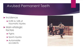 Avulsed Permanent Teeth
 Incidence
 0.5% to 16% of
traumatic injuries
 Main etiologic
factors
 Fights
 Sports injuries
 Automobile
accidents
 