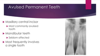 Avulsed Permanent Teeth
 Maxillary central incisor
 Most commonly avulsed
tooth
 Mandibular teeth
 Seldom affected
 Most frequently involves
a single tooth
 