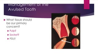 Management of the
Avulsed Tooth
 What tissue should
be our primary
concern?
 Pulp?
 Socket?
 PDL?
 