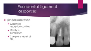 Periodontal Ligament
Responses
 Surface resorption
 Superficial
resorption cavities
 Mainly in
cementum
 Complete repair of
PDL
 