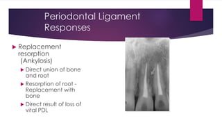 Periodontal Ligament
Responses
 Replacement
resorption
(Ankylosis)
 Direct union of bone
and root
 Resorption of root -
Replacement with
bone
 Direct result of loss of
vital PDL
 