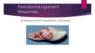 Periodontal Ligament
Responses
 Surface resorption
 Replacement resorption (Ankylosis)
 