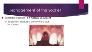 Management of the Socket
 Examine socket  If fracture is evident
 Reposition fractured bone with a blunt
instrument
 