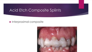 Acid Etch Composite Splints
 Interproximal composite
 