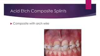 Acid Etch Composite Splints
 Composite with arch wire
 