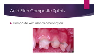Acid Etch Composite Splints
 Composite with monofilament nylon
 