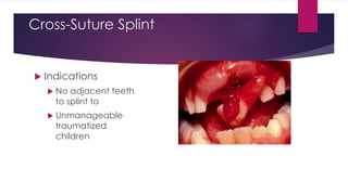 Cross-Suture Splint
 Indications
 No adjacent teeth
to splint to
 Unmanageable
traumatized
children
 