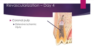 Revascularization – Day 4
 Coronal pulp
 Extensive ischemic
injury
 