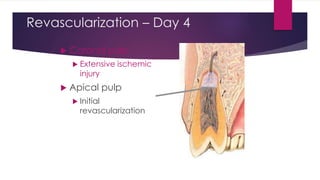 Revascularization – Day 4
 Coronal pulp
 Extensive ischemic
injury
 Apical pulp
 Initial
revascularization
 