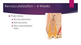 Revascularization – 4 Weeks
 Pulp status
 Revascularization
 Reinnervation
 New odontoblastic
layer
 