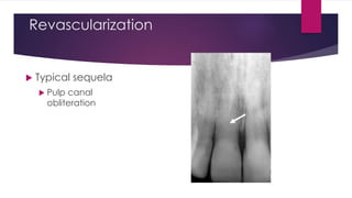 Revascularization
 Typical sequela
 Pulp canal
obliteration
 