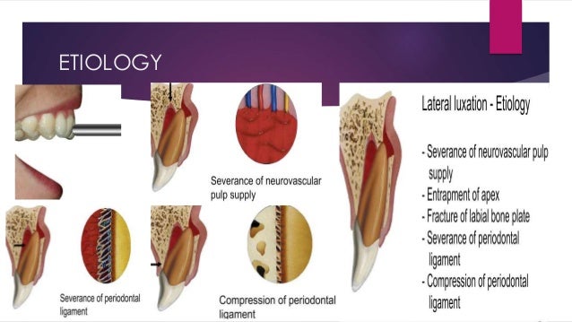 luxation tooth injuries tooth luxation