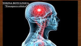 TOXINA BOTULINICA-
“Enxaqueca crônica”
 