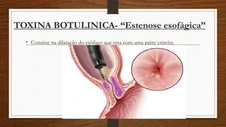 TOXINA BOTULINICA- “Estenose esofágica”
• Consiste na dilatação do esôfago que esta com uma parte estreita.
 