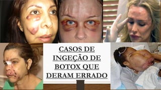 CASOS DE
INGEÇÃO DE
BOTOX QUE
DERAM ERRADO
 
