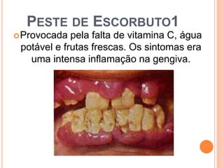 PESTE DE ESCORBUTO1
Provocada pela falta de vitamina C, água
potável e frutas frescas. Os sintomas era
uma intensa inflamação na gengiva.
 