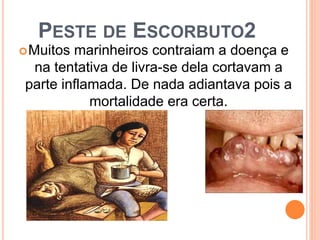 PESTE DE ESCORBUTO2
Muitos marinheiros contraiam a doença e
na tentativa de livra-se dela cortavam a
parte inflamada. De nada adiantava pois a
mortalidade era certa.
 