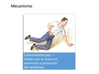 Mecanismo
Comúnmente por: –
Caídas con la mano en
extensión y pronación
del antebrazo
 