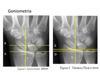 Goniometria
10mm 1-2mm
 