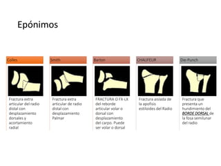 Epónimos
Fractura extra
articular del radio
distal con
desplazamiento
dorsales y
acortamiento
radial
Colles
Fractura extra
articular de radio
distal con
desplazamiento
Palmar
Smith
FRACTURA O FX-LX
del reborde
articular volar o
dorsal con
desplazamiento
del carpo. Puede
ser volar o dorsal
Barton
Fractura aislada de
la apofisis
estiloides del Radio
CHAUFEUR
Fractura que
presenta un
hundimiento del
BORDE DORSAL de
la fosa semilunar
del radio
Die-Punch
 