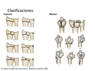 Clasificaciones
Frykman Melone
D. Green Cirugía de mano vol 1, Marban, España, 2007
 