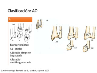 Clasificación: AO
Extraarticulares:
A1 : cubito
A2: radio simple e
impactada
A3: radio
multifragmentaria
A
D. Green Cirugía de mano vol 1, Marban, España, 2007
 