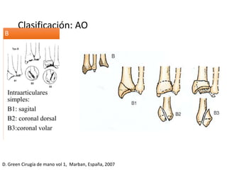 Clasificación: AO
Intraarticulares
simples:
B1: sagital
B2: coronal dorsal
B3:coronal volar
B
D. Green Cirugía de mano vol 1, Marban, España, 2007
 