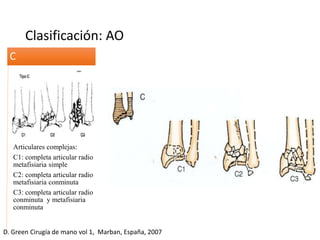 Clasificación: AO
Articulares complejas:
C1: completa articular radio
metafisiaria simple
C2: completa articular radio
metafisiaria conminuta
C3: completa articular radio
conminuta y metafisiaria
conminuta
C
D. Green Cirugía de mano vol 1, Marban, España, 2007
 