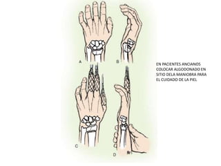 EN PACIENTES ANCIANOS
COLOCAR ALGODONADO EN
SITIO DELA MANIOBRA PARA
EL CUIDADO DE LA PIEL
 