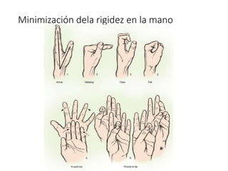 Minimización dela rigidez en la mano
 