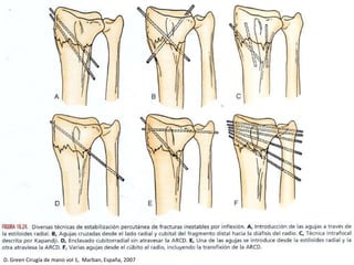 D. Green Cirugía de mano vol 1, Marban, España, 2007
 