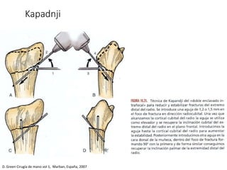 Kapadnji
D. Green Cirugía de mano vol 1, Marban, España, 2007
 