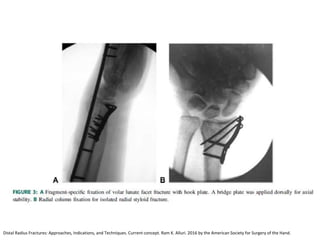 Distal Radius Fractures: Approaches, Indications, and Techniques. Current concept. Ram K. Alluri. 2016 by the American Society for Surgery of the Hand.
 
