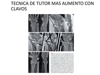 TECNICA DE TUTOR MAS AUMENTO CON
CLAVOS
 