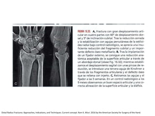 Distal Radius Fractures: Approaches, Indications, and Techniques. Current concept. Ram K. Alluri. 2016 by the American Society for Surgery of the Hand.
 