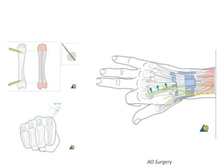 AO Surgery
 