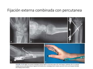 Fijación externa combinada con percutanea
 