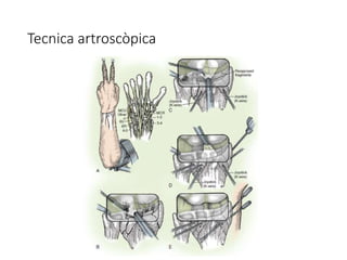 Tecnica artroscòpica
 