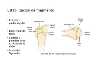 Estabilización de fragmento
• Estiloides
piedra angular .
• Borde volar del
radio
• C dorsal y
palmares de la
carilla lunar del
radio
• La cavidad
Sigmoidea
 