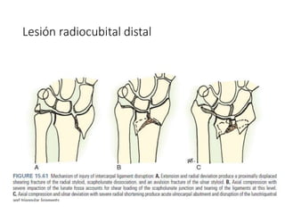 Lesión radiocubital distal
 