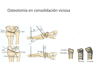 Osteotomía en consolidación viciosa
 