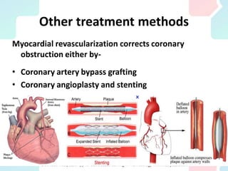 Other treatment methods
Myocardial revascularization corrects coronary
obstruction either by-
• Coronary artery bypass grafting
• Coronary angioplasty and stenting
 