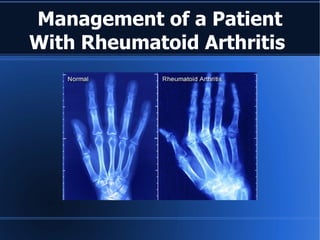 Management of a Patient With Rheumatoid Arthritis  