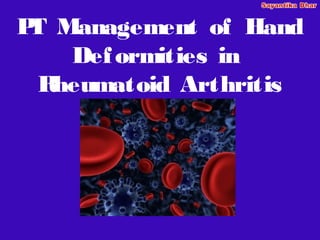 P Management of Hand
 T
    Def ormities in
 R heumatoid Arthritis
 