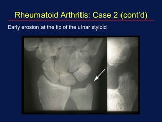 Rheumatoid Arthritis: Case 2 (cont’d)
Early erosion at the tip of the ulnar styloid
 