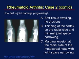 A. Soft-tissue swelling,
no erosions
B. Thinning of the cortex
on the radial side and
minimal joint space
narrowing
C. Marginal erosion at
the radial side of the
metacarpal head with
joint space narrowing
How fast is joint damage progressing?
Rheumatoid Arthritis: Case 2 (cont’d)
ACR Clinical Slide Collection, 1997.
 
