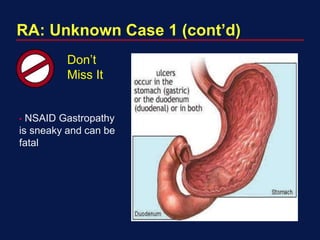 RA: Unknown Case 1 (cont’d)
Don’t
Miss It
• NSAID Gastropathy
is sneaky and can be
fatal
 