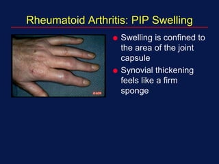Rheumatoid Arthritis: PIP Swelling
 Swelling is confined to
the area of the joint
capsule
 Synovial thickening
feels like a firm
sponge
 