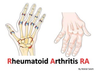 Rheumatoid Arthritis RA
By Mahdi Saleh
 
